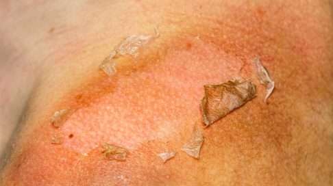 Pahoin palanut iho hilseilee, kesii, tai jopa kuoriutuu liuskoina pois pari päivää palamisen jälkeen. Kuva: iStock