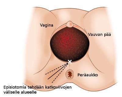 Silja Seppänen muistuttaa, ettei episiotomiaa pitäisi tehdä rutiinitoimenpiteenä. Kätilö keskustelee toimenpiteen tekemisestä aina äidin kanssa.