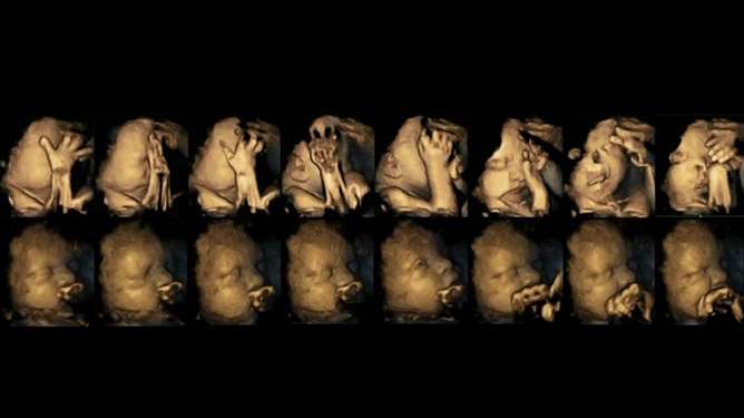 Ultrakuvat 32. raskausviikolta kertovat karua kieltä: Ylempi kuvasarja kuvaa tupakoivan äidin sikiön liikkeitä, alempi kuvasarja kuvaa tupakoimattoman äidin lapsen liikkeitä. Tupakoinnin vaikutus on selvästi nähtävissä.