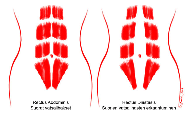 Vatsalihasten erkauma suorissa vatsalihaksissa