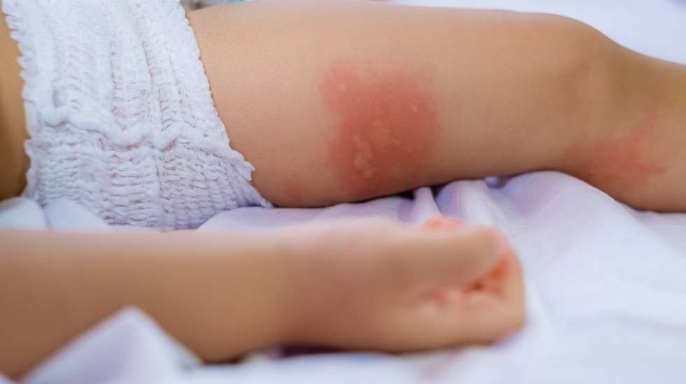 Punoittava ihottuma lapsella voi johtua monesta syystä – yksi niistä on ruoka-aineallergia. Kuva: iStock