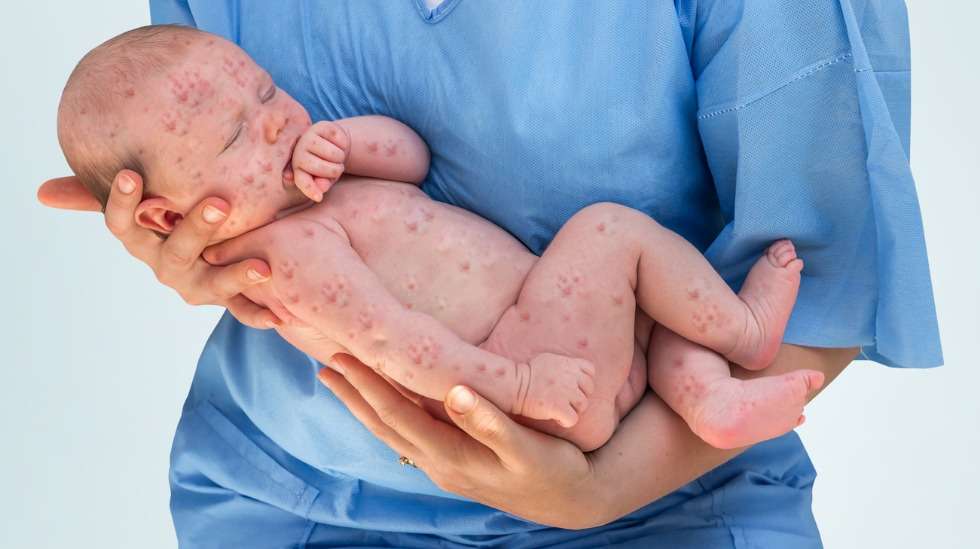 Tuhkarokko on yksi tarttuvimmista taudeista, eikä sen hoitoon ole olemassa lääkettä. Ainoa tapa suojautua tuhkarokolta ja sen jälkitaudeilta on rokotus. Kuva: iStock