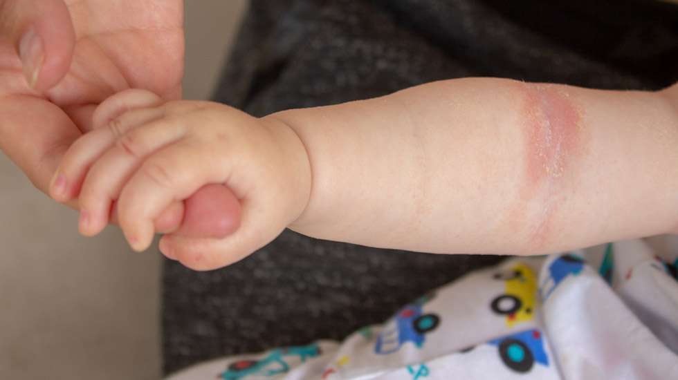 Jopa 10-20 prosenttia lapsista kärsii atooppisesta ihottumasta. Kuva: iStock