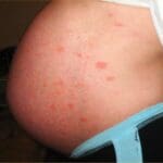 monimuotoinen-raskausihottuma