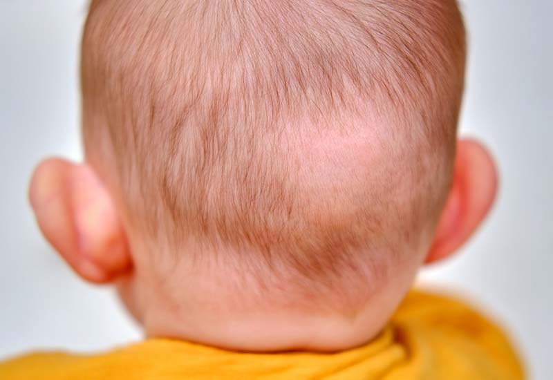 Vauva voi menettää osan tai kaikki hiuksistaan syntymän jälkeen. Se voi johtua hormoneista, mekaanisesta rasituksesta, hiusten kasvusylistä ja joskus harvoin sairauksista. (Kuva: iStock)