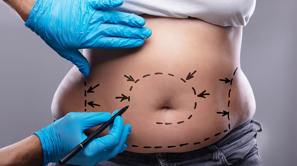 Voisitko harkita kauneuskirurgiaa raskauden aiheuttamien muutosten korjaamiseksi? (Kuva: iStock)